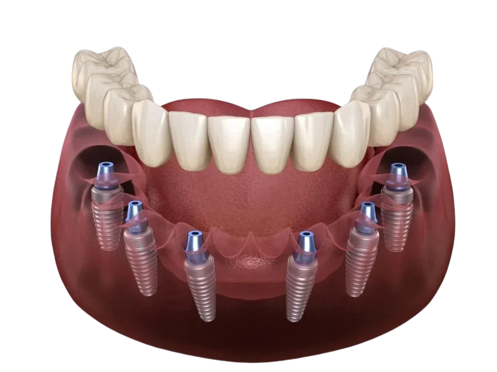All-on-6 implantati