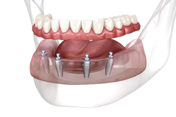 All-on-4 implantati